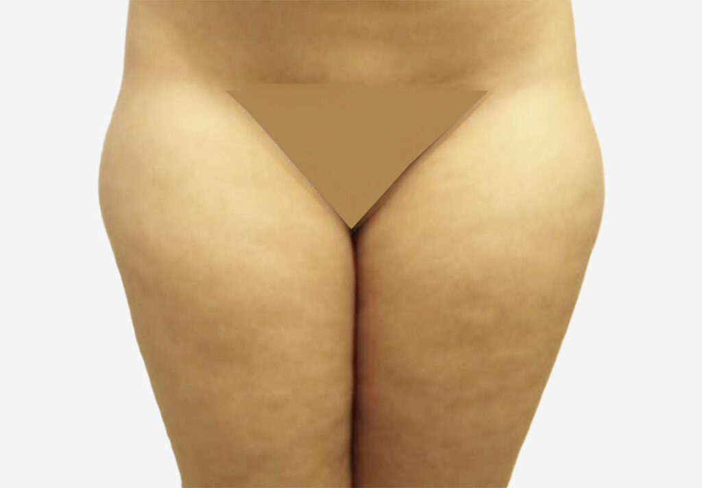 Liposuction Case 412 Before Photo Liposuction