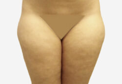 Liposuction
