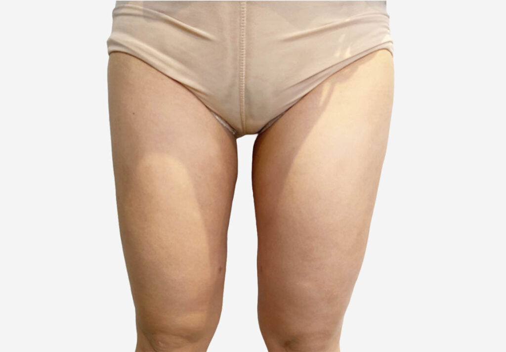 Liposuction