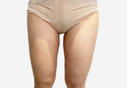 Liposuction
