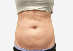 Liposuction