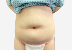 Liposuction