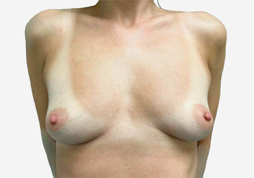 Breast Augmentation