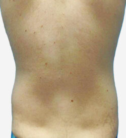 Liposuction