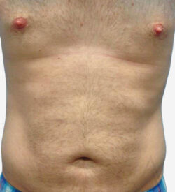 Liposuction
