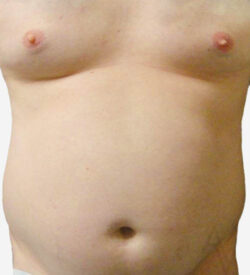 Liposuction