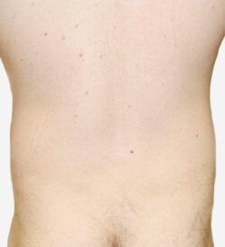 Liposuction