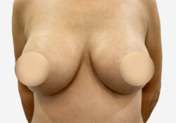 Breast Augmentation