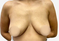 Breast Augmentation