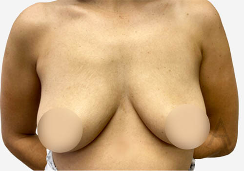 Breast Augmentation Case 3431 Before Photo Breast Augmentation