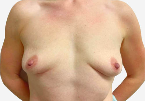 Breast Lift