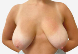 Breast Lift