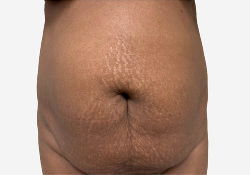 Tummy Tuck Case 59807 Before Photo Tummy Tuck