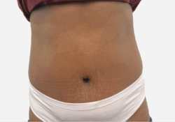 Tummy Tuck
