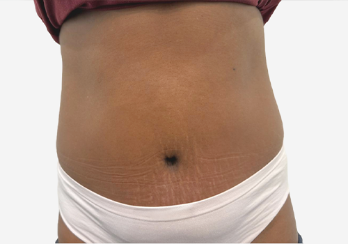 Tummy Tuck Case 59807 After Photo Tummy Tuck