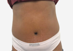 Tummy Tuck