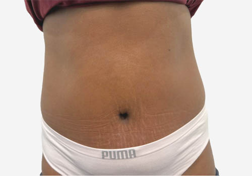 Tummy Tuck Case 59807 After Photo Tummy Tuck