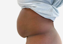 Tummy Tuck
