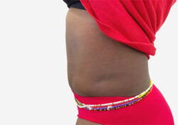 Tummy Tuck