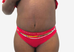 Tummy Tuck