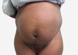 Tummy Tuck