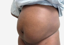 Tummy Tuck