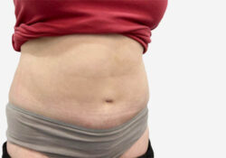 Tummy Tuck