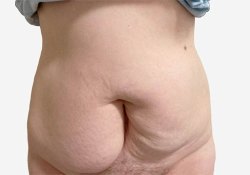 Tummy Tuck Case 18008 Before Photo Tummy Tuck