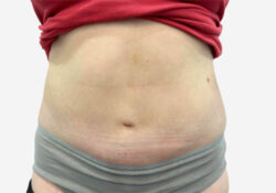 Tummy Tuck