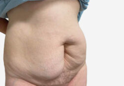 Tummy Tuck