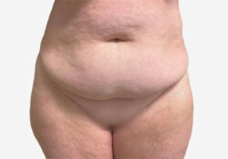 Tummy Tuck