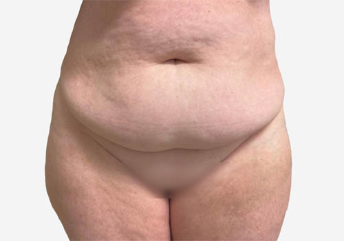 Tummy Tuck