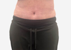 Tummy Tuck