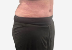 Tummy Tuck
