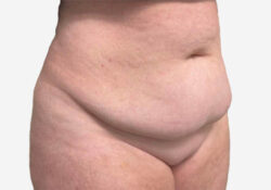 Tummy Tuck