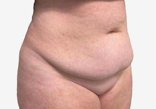 Tummy Tuck