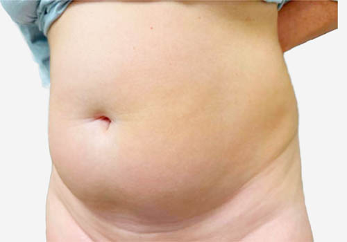Liposuction