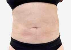 Liposuction