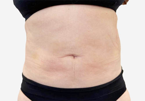 Liposuction Case 61350 After Photo Liposuction