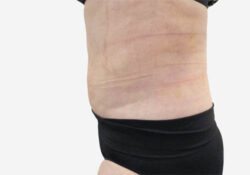 Liposuction