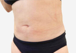 Liposuction