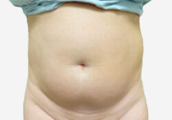Liposuction
