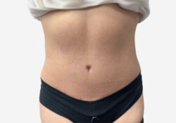 Tummy Tuck