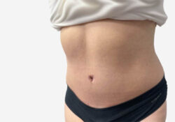 Tummy Tuck