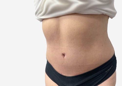 Tummy Tuck