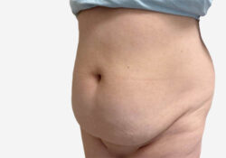 Tummy Tuck