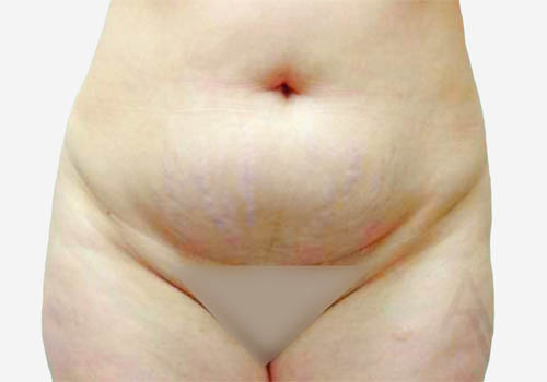 Tummy Tuck Case 411 Before Photo Tummy Tuck