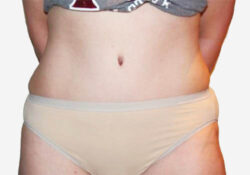Tummy Tuck