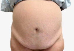 Tummy Tuck