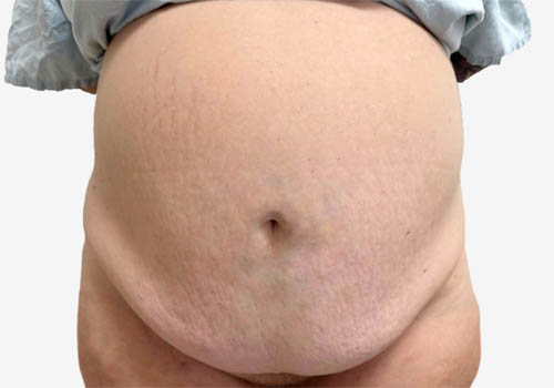 Tummy Tuck Case 20923 Before Photo Tummy Tuck